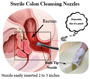 drawing of internal body parts - rectum and insercion of colon cleansing nozzle